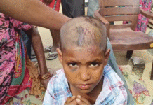 श्रीकरणपुर में श्वानों का आतंक, 7 वर्षीय बच्ची पर हमला